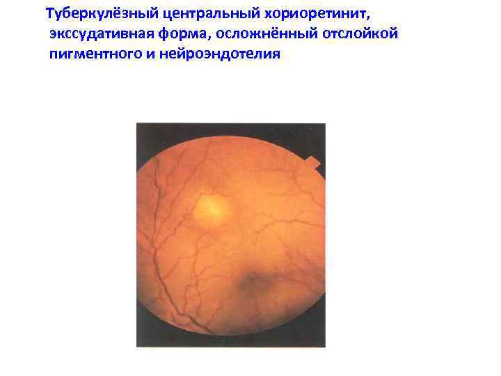  Туберкулёзный центральный хориоретинит, экссудативная форма, осложнённый отслойкой пигментного и нейроэндотелия 
