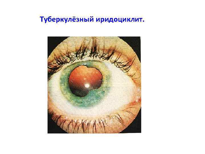 Туберкулёзный иридоциклит. 