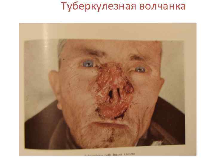 Туберкулезная волчанка 