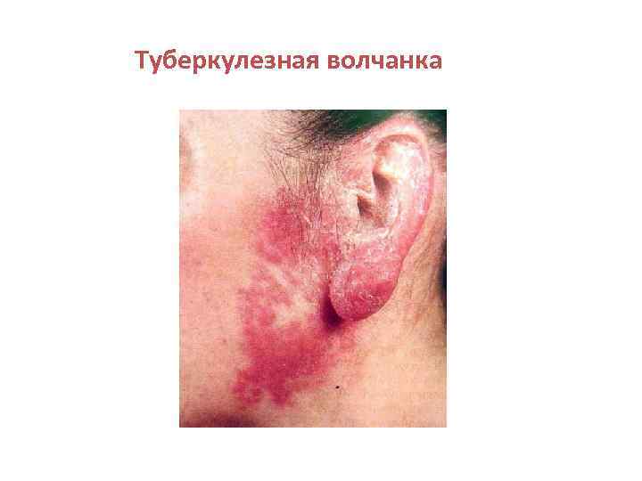 Туберкулезная волчанка 