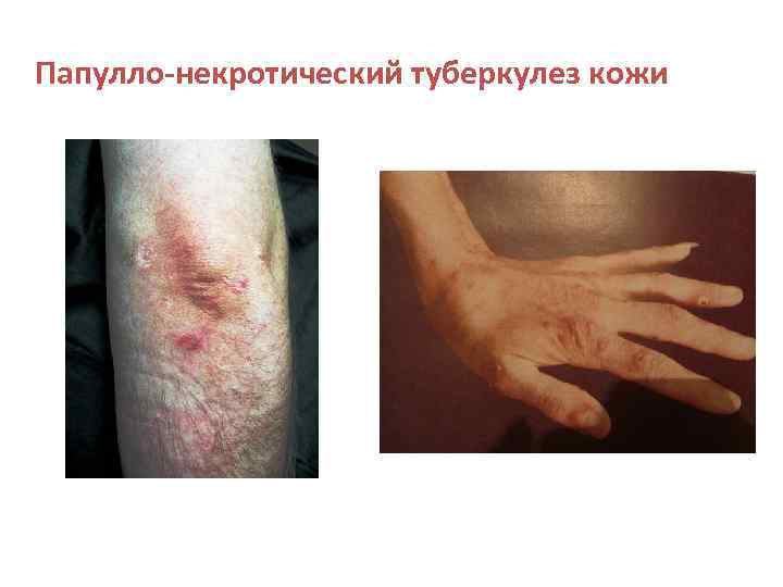 Папулло-некротический туберкулез кожи 