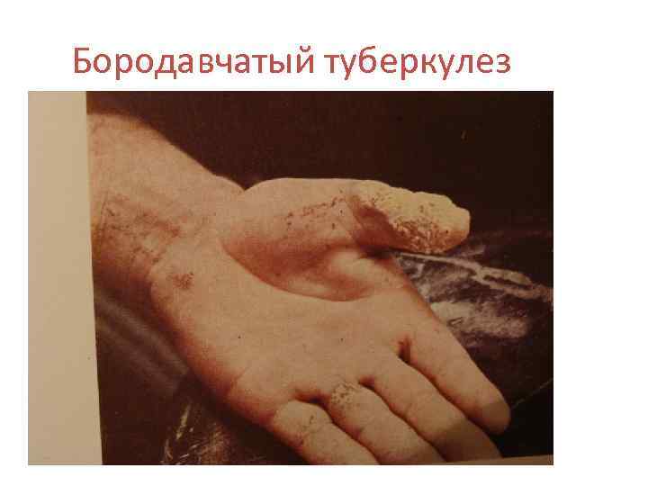 Бородавчатый туберкулез 