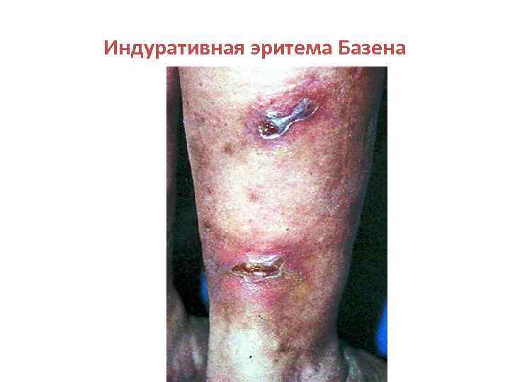 Индуративная эритема Базена 