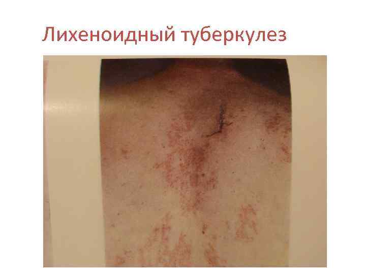 Лихеноидный туберкулез 