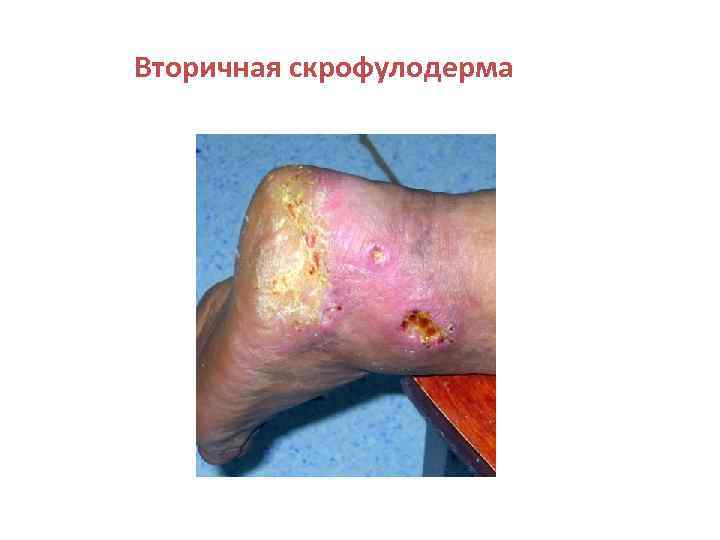 Вторичная скрофулодерма 