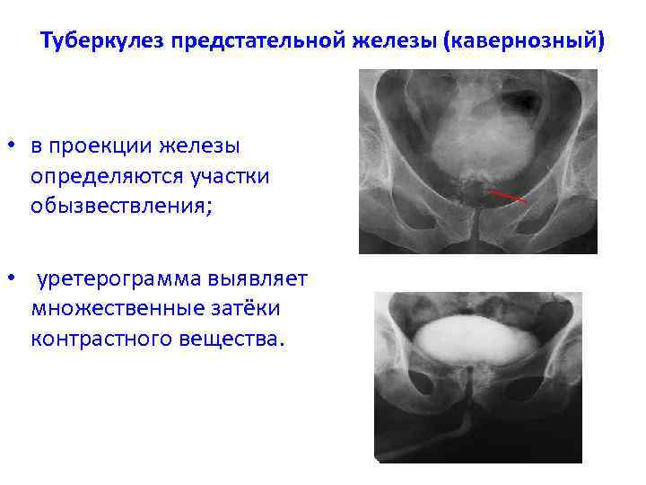 Туберкулез мужских органов презентация