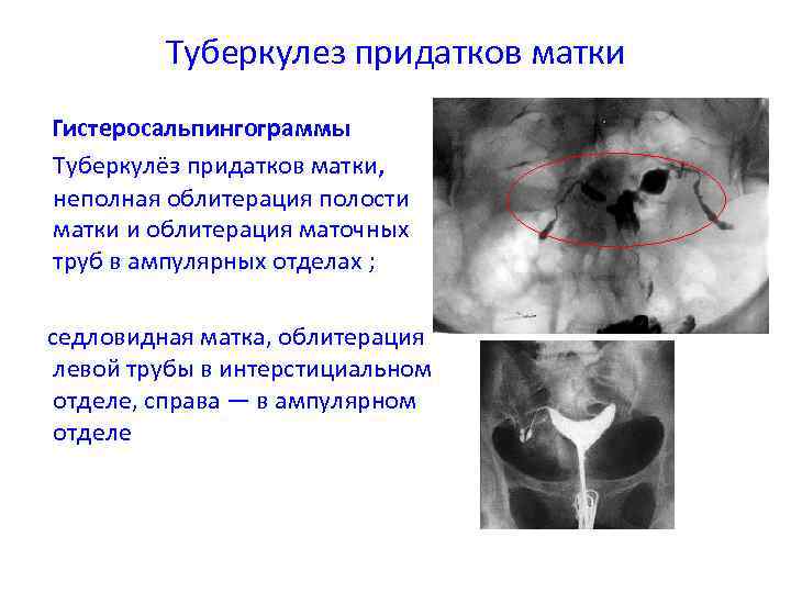Туберкулез придатков матки Гистеросальпингограммы Туберкулёз придатков матки, неполная облитерация полости матки и облитерация маточных