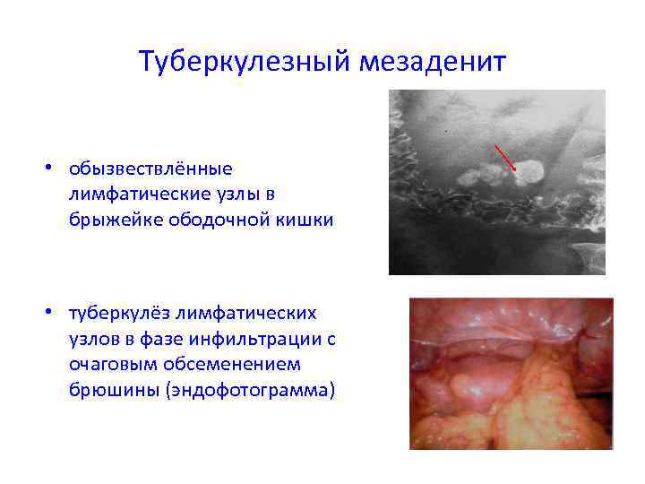 Внелегочный туберкулез презентация