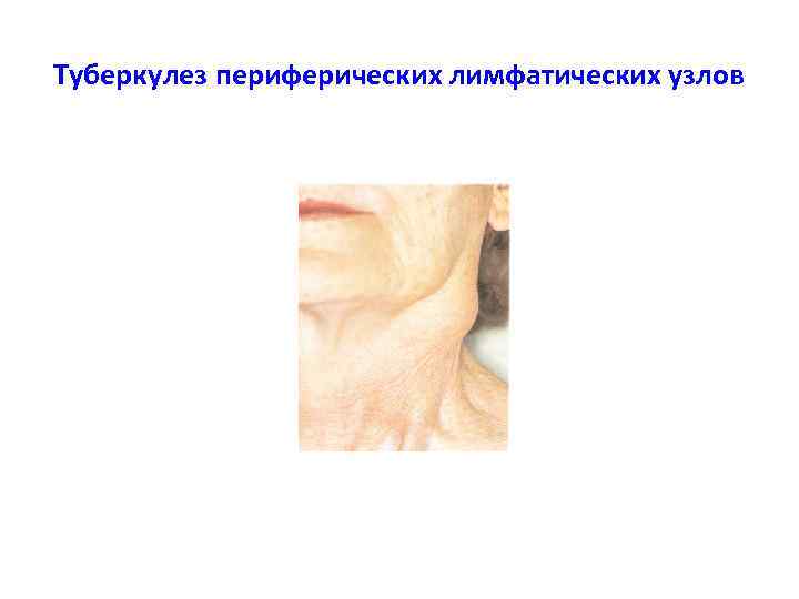Туберкулез периферических лимфатических узлов 