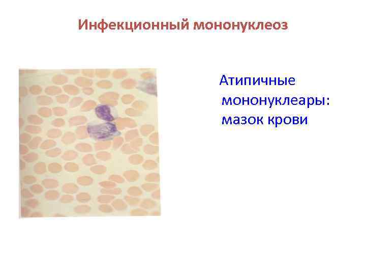 Мононуклеары. Атипичные мононуклеары в крови. Мазок крови атипичные мононуклеары. Инфекционный мононуклеоз мазок крови. Инфекционный мононуклеоз атипичные мононуклеары.