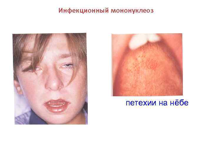 Инфекционный мононуклеоз петехии на нёбе 