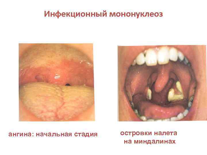 Инфекционный мононуклеоз ангина: начальная стадия островки налета на миндалинах 