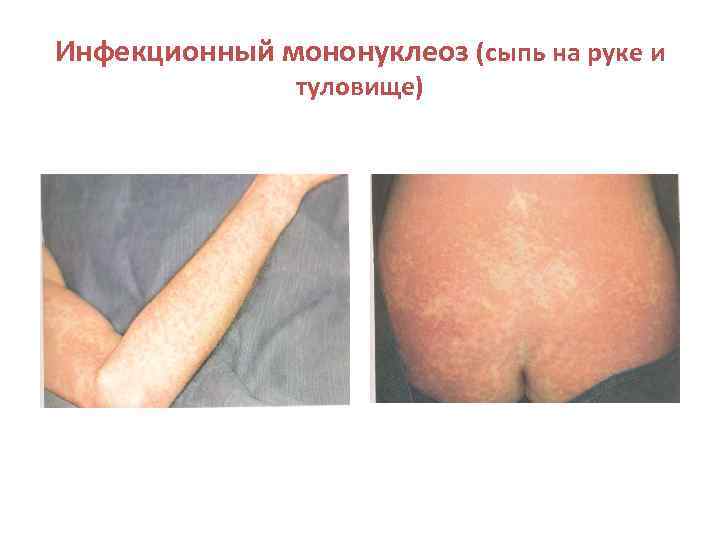 Инфекционный мононуклеоз (сыпь на руке и туловище) 