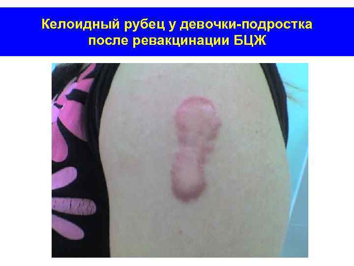 Келоидный рубец у девочки-подростка после ревакцинации БЦЖ 