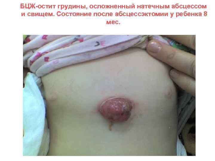 БЦЖ-остит грудины, осложненный натечным абсцессом и свищем. Состояние после абсцессэктомии у ребенка 8 мес.
