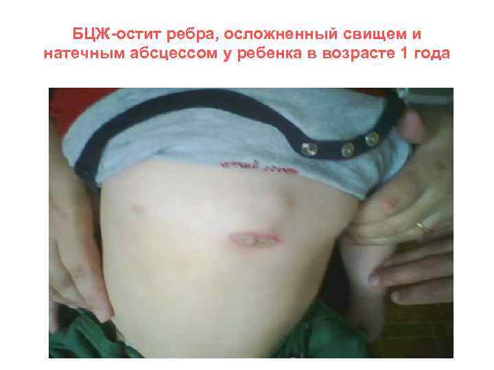 БЦЖ-остит ребра, осложненный свищем и натечным абсцессом у ребенка в возрасте 1 года 