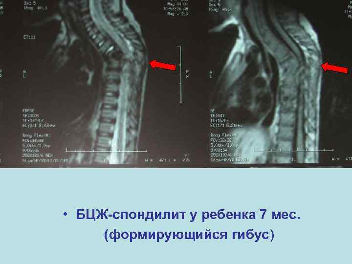  • БЦЖ-спондилит у ребенка 7 мес. (формирующийся гибус) 