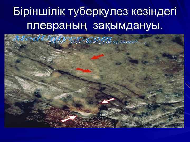 Біріншілік туберкулез кезіндегі плевраның зақымдануы. 