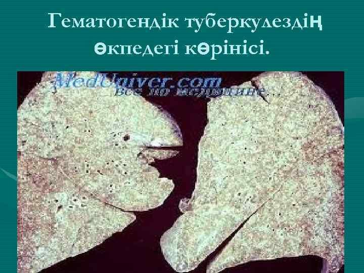 Гематогендік туберкулездің өкпедегі көрінісі. 