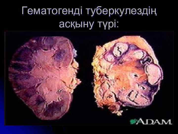 Гематогенді туберкулездің асқыну түрі: 