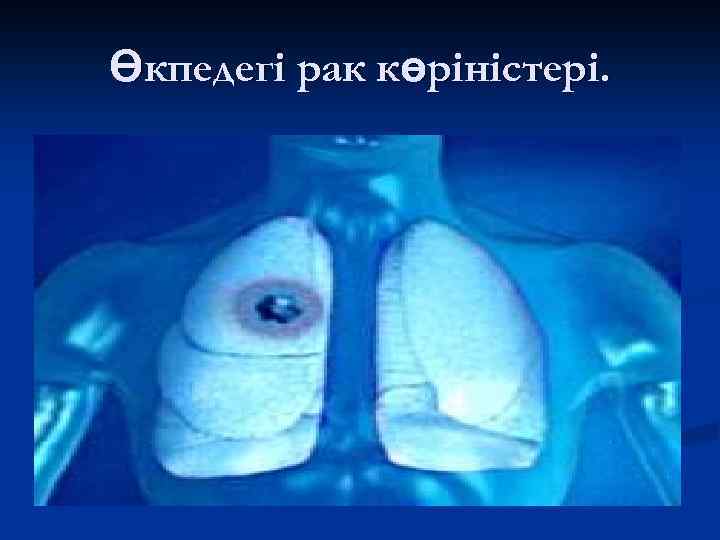 Өкпедегі рак көріністері. 