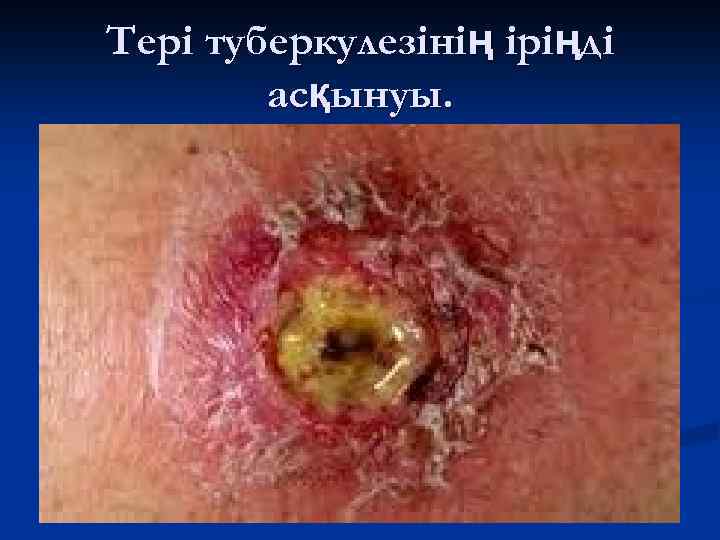 Тері туберкулезінің іріңді асқынуы. 