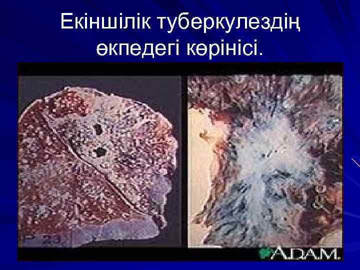 Екіншілік туберкулездің өкпедегі көрінісі. 