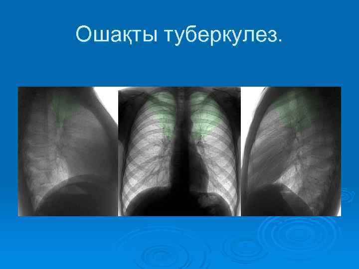 Ошақты туберкулез. 