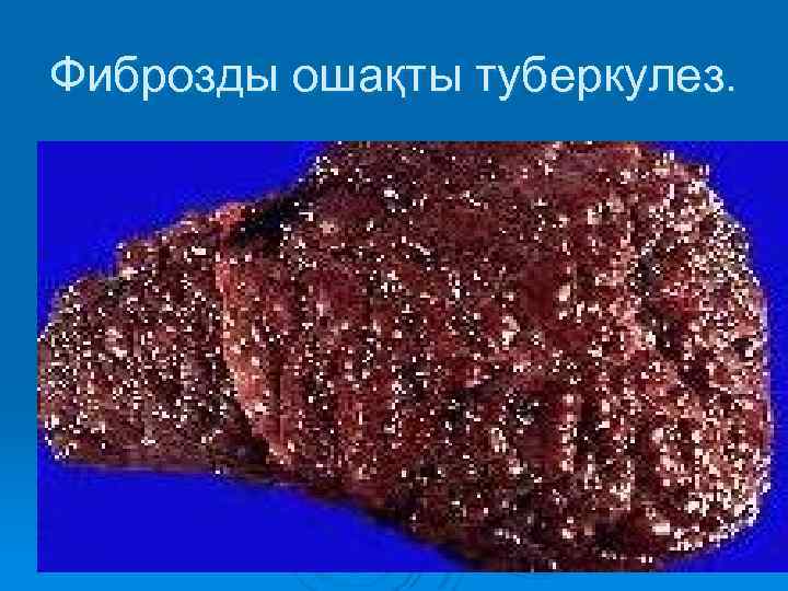 Фиброзды ошақты туберкулез. 