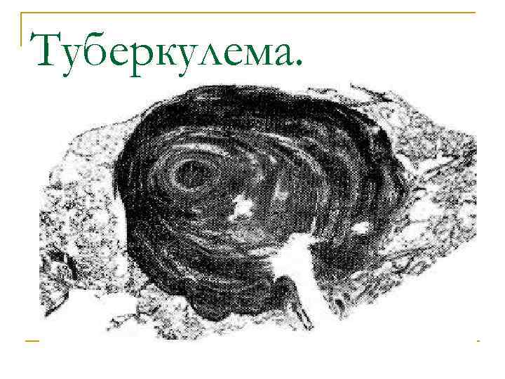 Туберкулема. 