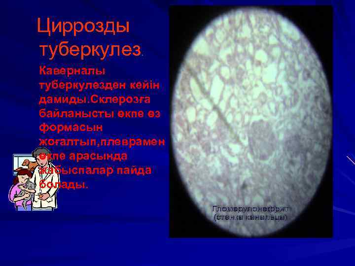 Циррозды туберкулез. Каверналы туберкулезден кейін дамиды. Склерозға байланысты өкпе өз формасын жоғалтып, плеврамен өкпе