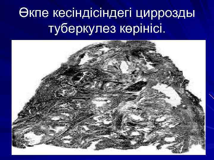 Өкпе кесіндісіндегі циррозды туберкулез көрінісі. 