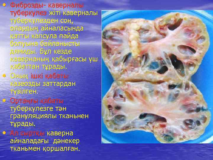  • Фиброзды- каверналы • • • туберкулез жіті каверналы туберкулезден соң, олардың айналасында