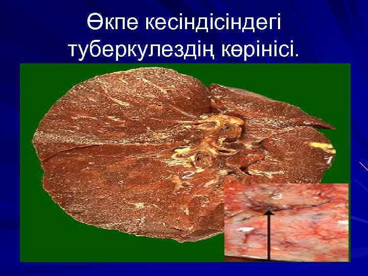 Өкпе кесіндісіндегі туберкулездің көрінісі. 