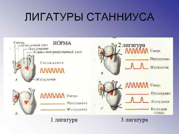 ЛИГАТУРЫ СТАННИУСА НОРМА 1 лигатура 2 лигатура 3 лигатура 