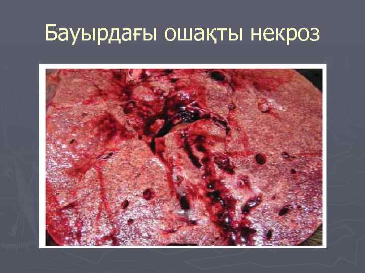 Бауырдағы ошақты некроз 
