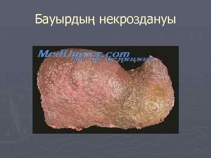Бауырдың некроздануы 