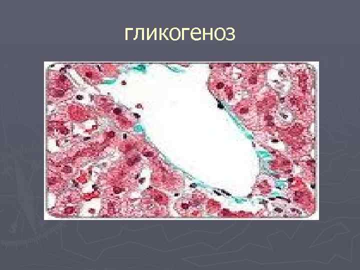 гликогеноз 