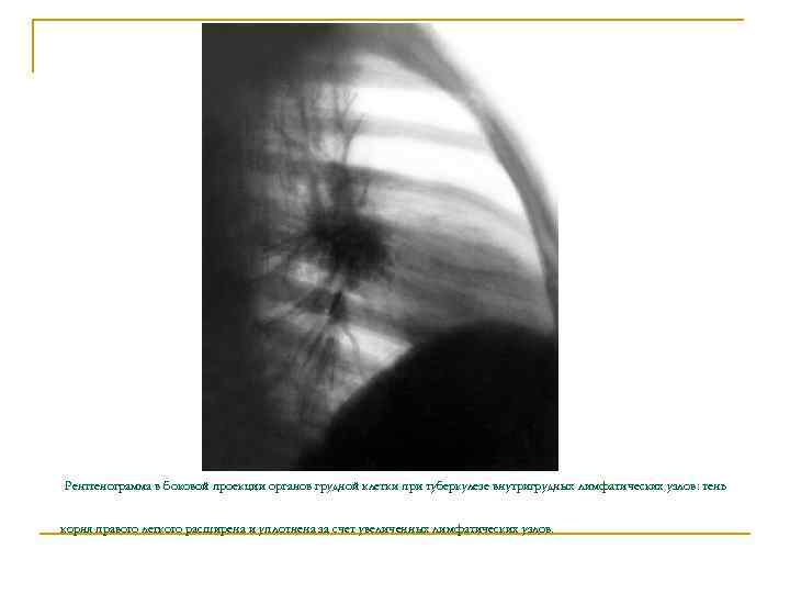  Рентгенограмма в боковой проекции органов грудной клетки при туберкулезе внутригрудных лимфатических узлов: тень