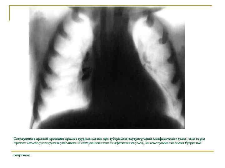 Томограмма в прямой проекции органов грудной клетки при туберкулезе внутригрудных лимфатических узлов: тень корня