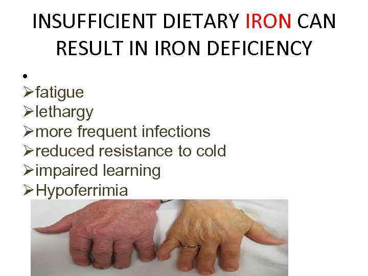 INSUFFICIENT DIETARY IRON CAN RESULT IN IRON DEFICIENCY • Øfatigue Ølethargy Ømore frequent infections