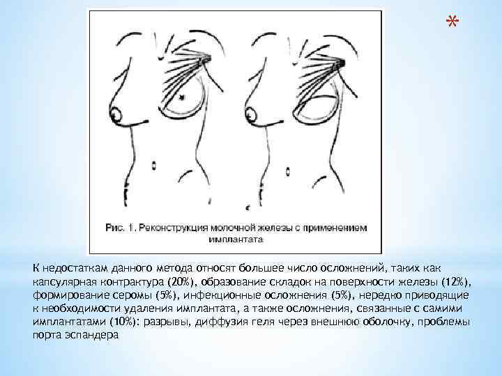 * К недостаткам данного метода относят большее число осложнений, таких как капсулярная контрактура (20%),
