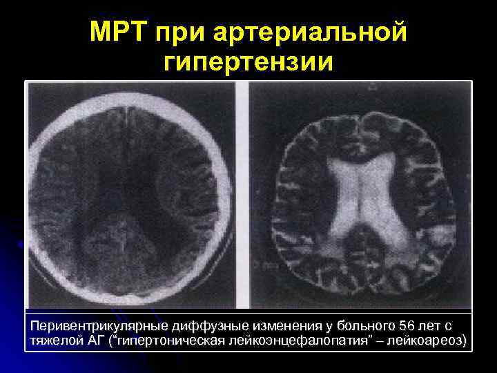 МРТ при артериальной гипертензии Перивентрикулярные диффузные изменения у больного 56 лет с тяжелой АГ