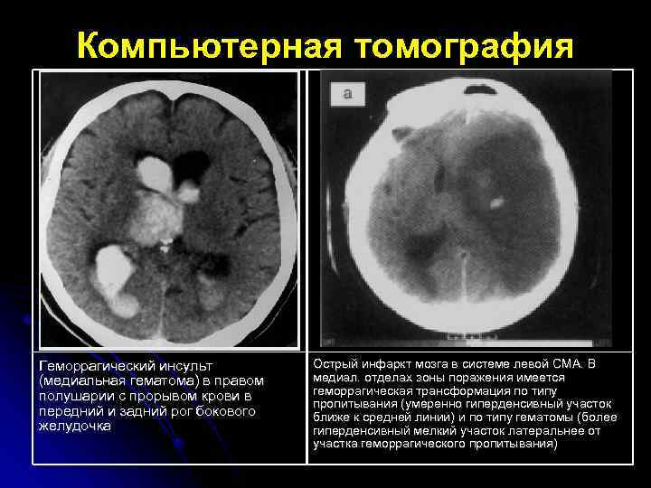 Показывает ли компьютерная томография инсульт