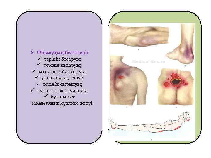 Ø Ойылудың белгілері: ü терінің бозаруы; ü терінің қызаруы; ü көк дақ пайда болуы;