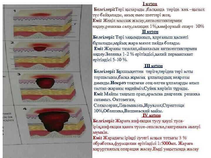 I кезең Белгілері: Тері қызарады , басқанда теріде көк –қызыл түс байқалады, анық емес