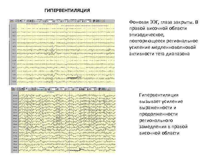 ГИПЕРВЕНТИЛЯЦИЯ Фоновая ЭЭГ, глаза закрыты. В правой височной области эпизодическое, повторяющееся региональное усиление медленноволновой