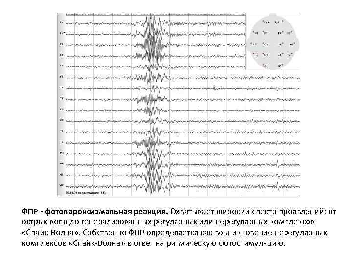 ФПР - фотопароксизмальная реакция. Охватывает широкий спектр проявлений: от острых волн до генерализованных регулярных