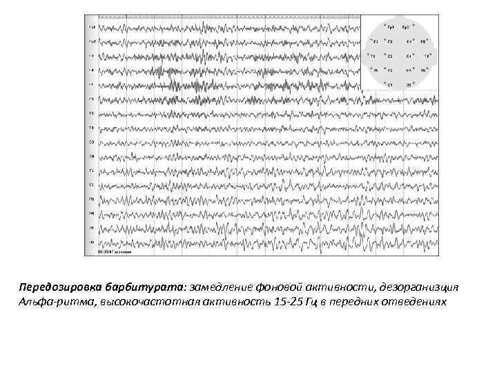 Передозировка барбитурата: замедление фоновой активности, дезорганизция Альфа-ритма, высокочастотная активность 15 -25 Гц в передних