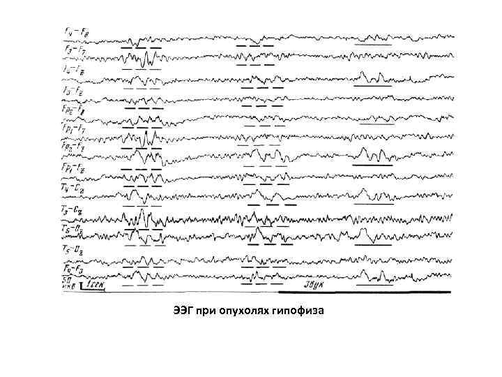 ЭЭГ при опухолях гипофиза 